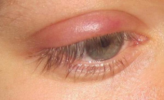 отек верхнего века